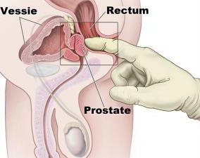 Dessin expliquant comment masser la prostate